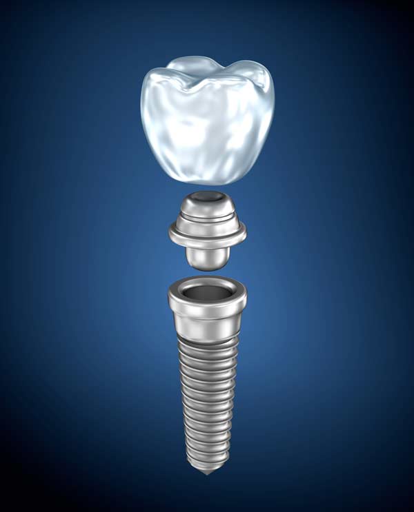 Dental Implant Claremore, OK | Healthy Smiles Family Dentistry